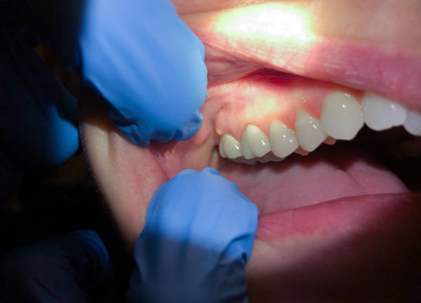 Best Emergency Root Canal Therapy in Lantana, TX