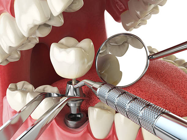 Best Knocked-Out Tooth (Avulsed Tooth) Treatment in Lantana, TX